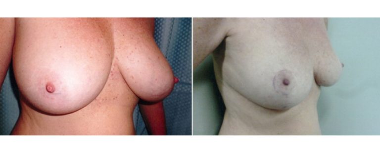 Reduction mammoplasty (patient's height 162 cm), before and after, angle view, Dr Richardson Brisbane