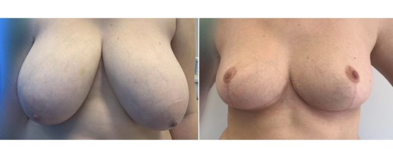 BPCS Brisbane, reduction mammoplasty surgery before and after 43, front view
