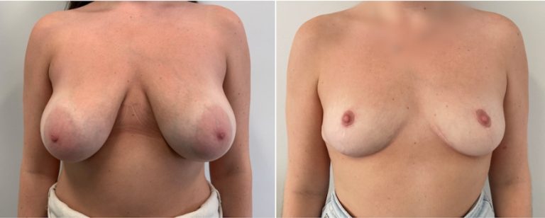 Breast reduction before and after 49, front view, BPCS Brisbane, Dr Richardson