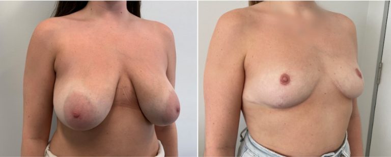 Breast reduction before and after 49, angle view, BPCS Brisbane, Dr Richardson