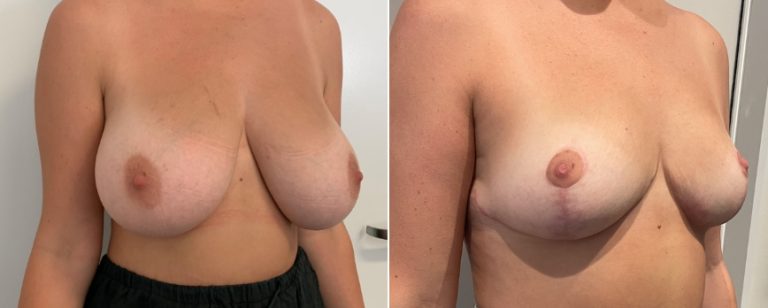 Breast reduction before and after 51, angle view, BPCS Brisbane, Dr Richardson