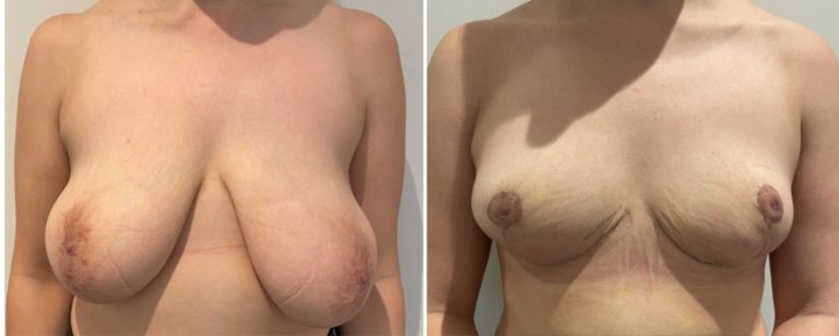 Breast reduction before and after 52, front view, BPCS Brisbane, Dr Richardson