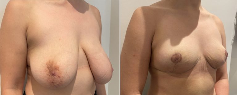 Breast reduction before and after 52, angle view, BPCS Brisbane, Dr Richardson