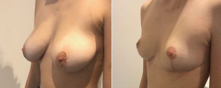 Breast reduction before and after 55, angle view, BPCS Brisbane