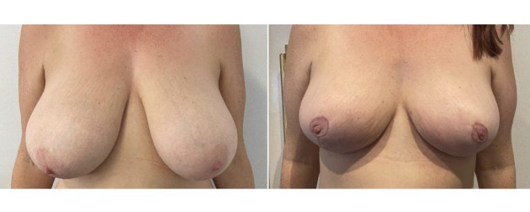 Breast reduction mammoplasty before and after 56 - front view, BPCS Brisbane Plastic Surgery