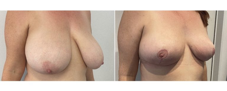 Breast reduction mammoplasty before and after 56 - angle view, BPCS Brisbane Plastic Surgery