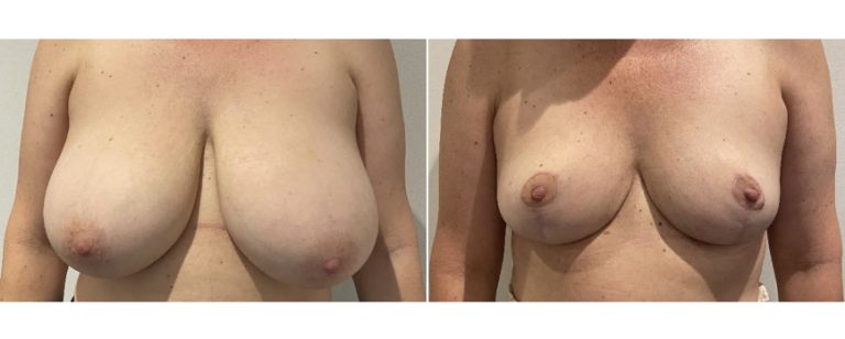 Breast reduction mammoplasty before and after 57 - front view, BPCS Brisbane Plastic Surgery