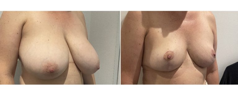 Breast reduction mammoplasty before and after 57 - side view, BPCS Brisbane Plastic Surgery