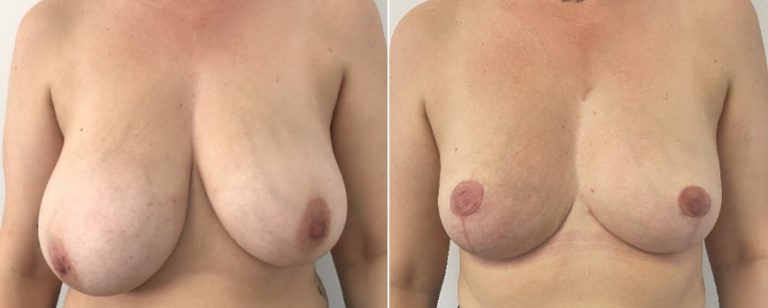 Breast reduction surgery, before and after 58 - front view, Dr Richardson, Brisbane Plastic Surgery