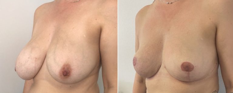Breast reduction surgery, before and after 58 - angle view, Dr Richardson, Brisbane Plastic Surgery