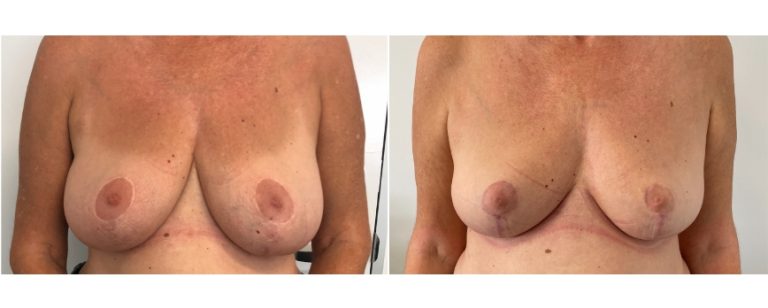 Breast reduction surgery, before and after 59 - front view, Dr Richardson, Brisbane Plastic Surgery