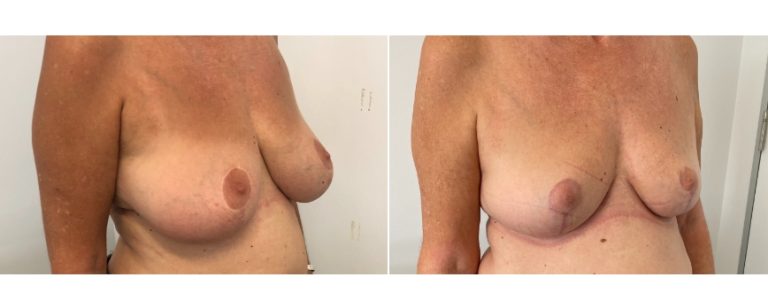 Breast reduction surgery, before and after 59 - angle view, Dr Richardson, Brisbane Plastic Surgery