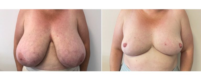 Breast reduction surgery, before and after 60 - front view, Dr Richardson, Brisbane Plastic Surgery