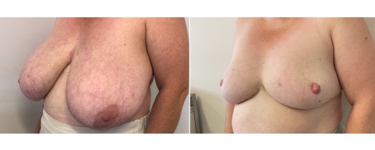 Breast reduction surgery, before and after 60 - side view, Dr Richardson, Brisbane Plastic Surgery