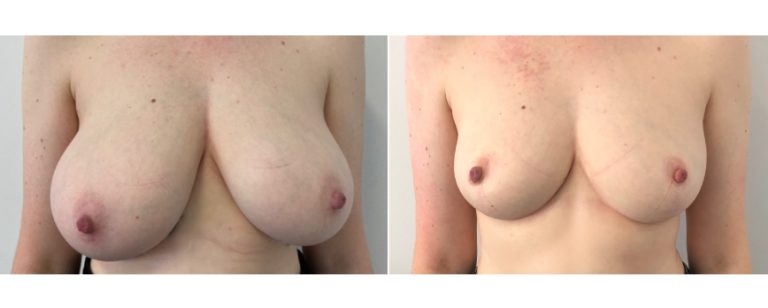 Breast reduction surgery, before and after 61 - front view, Dr Richardson, Brisbane Plastic Surgery