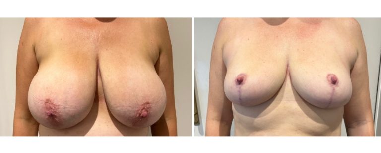Breast reduction surgery, before and after 62 - front view, Dr Richardson, Brisbane Plastic Surgery