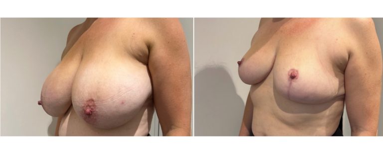 Breast reduction surgery, before and after 62 - angle view, Dr Richardson, Brisbane Plastic Surgery