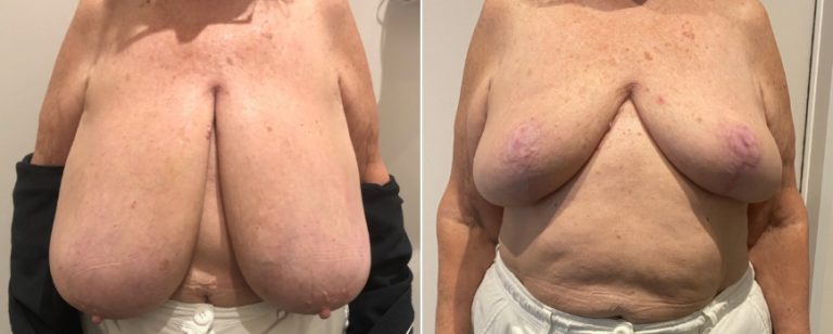 Breast reduction surgery, before and after 63 - front view, Dr Richardson, Brisbane Plastic Surgery