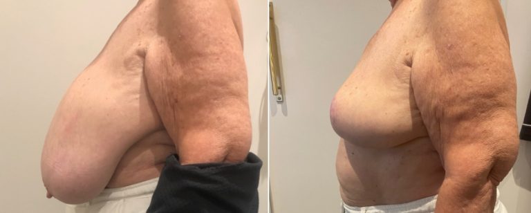 Breast reduction surgery, before and after 63 - side view, Dr Richardson, Brisbane Plastic Surgery