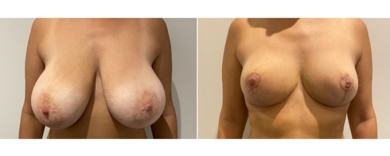 Breast reduction surgery, before and after 64 - front view, Dr Richardson, Brisbane Plastic Surgery