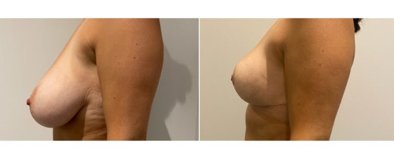 Breast reduction surgery, before and after 64 - side view, Dr Richardson, Brisbane Plastic Surgery