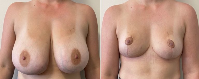 Breast reduction surgery, before and after 65 - front view, Dr Richardson Brisbane, BPCS