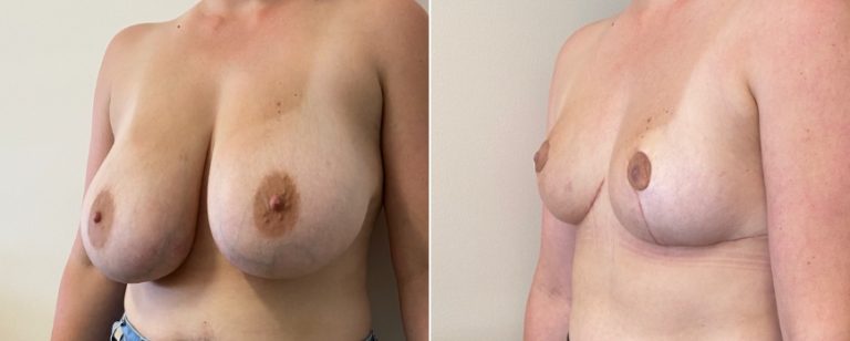 Breast reduction surgery, before and after 65 - angle view, Dr Richardson Brisbane, BPCS