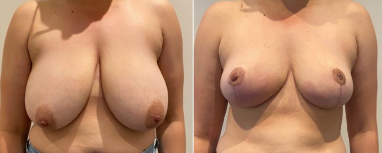 Breast reduction surgery, before and after 67 front, Dr Richardson Brisbane, BPCS