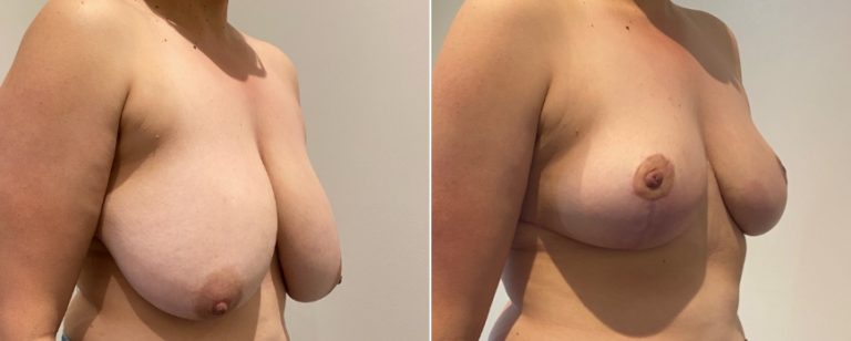Breast reduction surgery, before and after 67, angle view, Dr Richardson Brisbane, BPCS