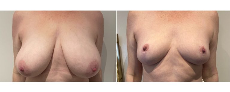 Breast reduction surgery, before and after 68, Dr Richardson Brisbane, BPCS