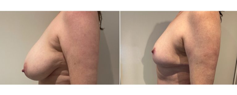 BPCS Brisbane, breast reduction patient, before and after 68, side view