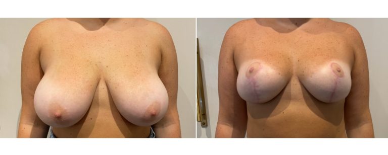 Breast reduction before and after 69, front view, BPCS Brisbane