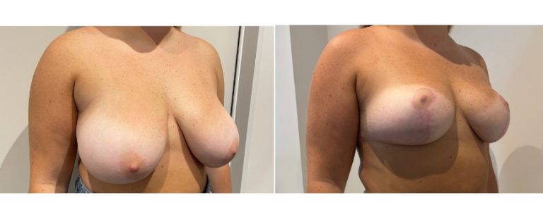 Breast reduction surgery results (before & afters) 69, angle view, Dr Richardson