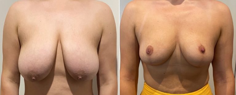 Breast reduction before and after 70, Dr Richardson Brisbane, front view