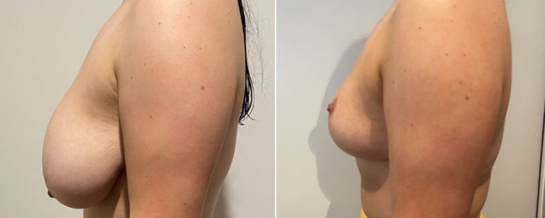 Patient before and after breast reduction 70, side view, BPCS Brisbane