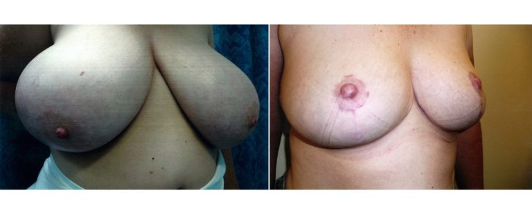 Reduction mammoplasty (age 45), before and after, angle view, Dr Richardson Brisbane
