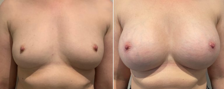 Breast augmentation surgery, before and after 211, front view, Dr Richardson, Brisbane, QLD