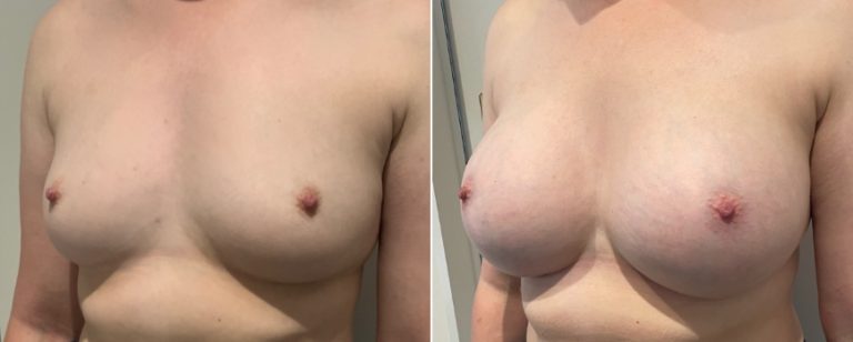 Breast augmentation (implants), before and after 211, angle view, Dr Richardson, Brisbane, QLD