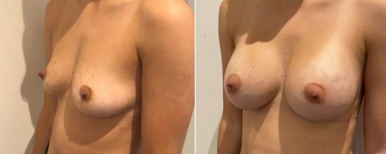 Breast augmentation (implants), before and after 212, angle view, Dr Richardson, Brisbane, QLD