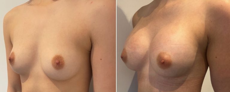 Breast augmentation (implants), before and after 213, angle view, Dr Richardson, Brisbane, QLD