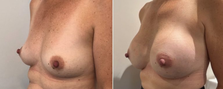 Breast augmentation (implants), before and after 214, angle view, Dr Richardson, Brisbane, QLD