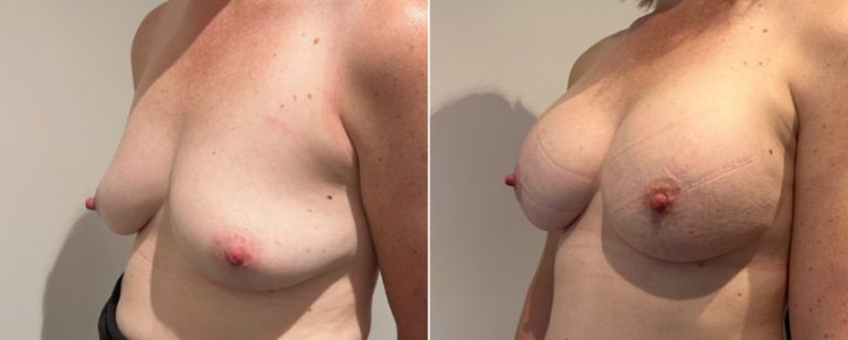 Breast augmentation (implants), before and after 215, angle view, Dr Richardson, Brisbane, QLD