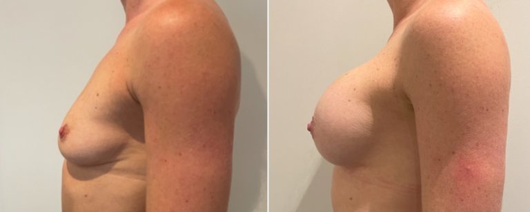 Breast augmentation (implants), before and after 216, side view, Dr Richardson, Brisbane, QLD