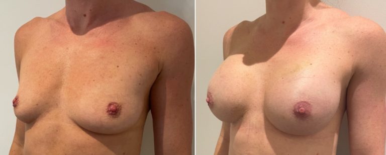 Breast augmentation (implants), before and after 216, angle view, Dr Richardson, Brisbane, QLD