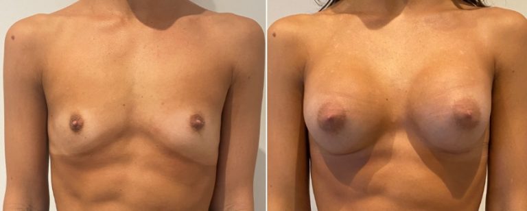 Breast augmentation (implants), before and after 217, front view, Dr Richardson, Brisbane, QLD