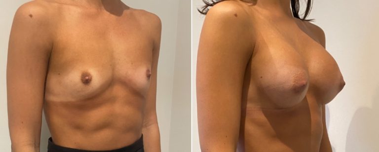 Breast augmentation (implants), before and after 217, angle view, Dr Richardson, Brisbane, QLD