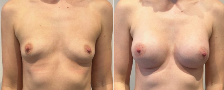 Breast augmentation before and after 218, front view, Dr Richardson Brisbane