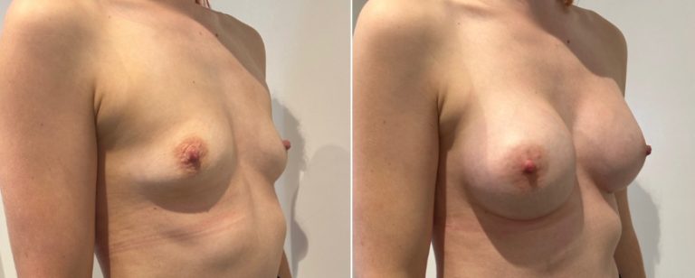 Breast augmentation before and after 218, angle view, Dr Richardson Brisbane