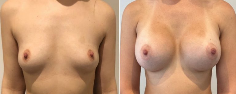 Augmentation mammoplasty surgery, before and after 219, front view, BPCS Brisbane