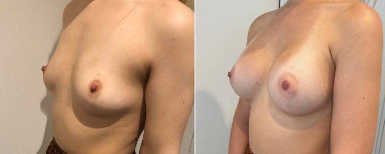 Augmentation mammoplasty surgery, before and after 219, angle view, BPCS Brisbane